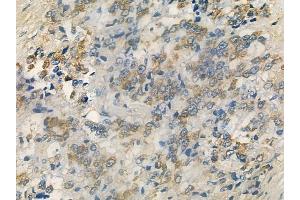 ABIN6259392 and ABIN6276159 at 1/100 staining human prostate carcinoma by IHC-P.