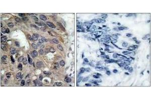 Immunohistochemistry analysis of paraffin-embedded human breast carcinoma, using Src (Phospho-Tyr529) Antibody. (Src 抗体  (pTyr530))