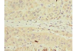 Immunohistochemistry of paraffin-embedded human liver cancer using ABIN7173011 at dilution of 1:100 (TMPRSS6 抗体  (AA 98-301))