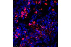 Immunofluorescence of paraffin embedded human lung cancer using AHSG (ABIN7073021) at dilution of 1:650 (400x lens) (Fetuin A 抗体)