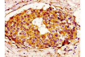 IHC image of ABIN7145162 diluted at 1:100 and staining in paraffin-embedded human breast cancer performed on a Leica BondTM system. (BCL3 抗体  (AA 362-454))