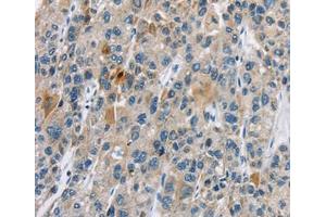 Immunohistochemical analysis of paraffin-embedded Human liver cancer tissue using at dilution 1/30. (CACNA2D1 抗体  (Internal Region))
