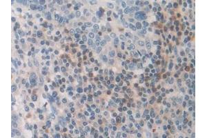 Detection of FDFT1 in Human Skin cancer Tissue using Polyclonal Antibody to Farnesyl Diphosphate Farnesyltransferase 1 (FDFT1) (FDFT1 抗体  (AA 269-417))