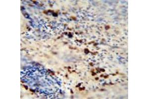 Immunohistochemistry analysis in human skin carcinoma (Formalin-fixed, Paraffin-embedded) using LCE1A  Antibody (C-term), followed by peroxidase conjugation of the secondary antibody and DAB staining. (LCE1A 抗体  (C-Term))