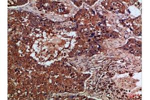 Immunohistochemical analysis of paraffin-embedded Human-lung-cancer, antibody was diluted at 1:100 (FLT4 抗体  (AA 720-760))
