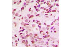 Immunohistochemical analysis of NEMF staining in human breast cancer formalin fixed paraffin embedded tissue section. (NEMF 抗体  (C-Term))