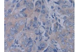 Detection of YARS in Human Breast cancer Tissue using Polyclonal Antibody to Tyrosyl tRNA Synthetase (YARS) (YARS 抗体  (AA 2-528))