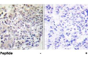 Immunohistochemical analysis of paraffin-embedded human breast carcinoma tissue using RAPGEF1 polyclonal antibody . (GRF2 抗体)