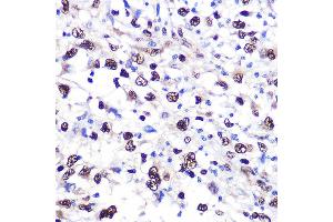 Immunohistochemistry of paraffin-embedded human liver cancer using NCL Rabbit pAb (ABIN6128392, ABIN6144411, ABIN6144412 and ABIN6221613) at dilution of 1:100 (40x lens). (Nucleolin 抗体  (AA 461-710))