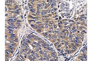 ABIN6258527 and ABIN6274787 at 1/100 staining human lung cancer and adjacent non-tumor tissue by IHC-P. (ABHD11 抗体  (C-Term))