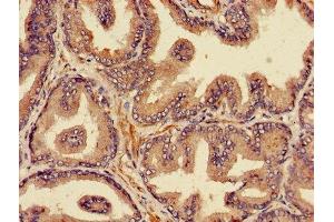Immunohistochemistry of paraffin-embedded human prostate cancer using ABIN7164978 at dilution of 1:100 (PSMB4 抗体  (AA 46-264))