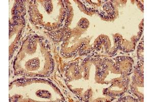 Immunohistochemistry of paraffin-embedded human prostate cancer using ABIN7164978 at dilution of 1:100