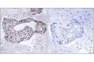 Immunohistochemistry analysis of paraffin-embedded human breast carcinoma tissue, using GATA1 (Ab-142) Antibody. (GATA1 抗体  (AA 109-158))