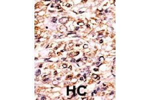 Formalin-fixed and paraffin-embedded human hepatocellular carcinoma tissue reacted with ESPL1 (phospho S1126) polyclonal antibody  which was peroxidase-conjugated to the secondary antibody followed by DAB staining. (Separase 抗体  (pSer1126))