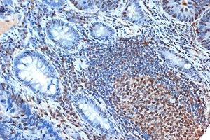 Immunohistochemistry of paraffin-embedded human colon carcinoma using FEN-1 Rabbit mAb (ABIN7267215) at dilution of 1:100 (40x lens). (FEN1 抗体)