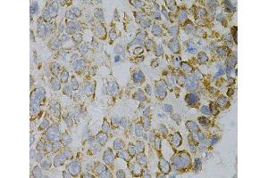 Immunohistochemistry of paraffin-embedded Human esophageal cancer using GNAO1 Polyclonal Antibody at dilution of 1:100 (40x lens). (GNAO1 抗体)