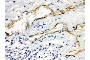 Anti- Aquaporin 1 Picoband antibody, IHC(P) IHC(P): Human Intestinal Cancer Tissue (Aquaporin 1 抗体  (C-Term))