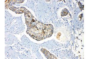 Periplakin was detected in paraffin-embedded sections of human oesophagus squama cancer tissues using rabbit anti- Periplakin Antigen Affinity purified polyclonal antibody (Catalog # ) at 1 µg/mL. (PPL 抗体  (C-Term))