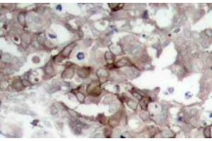 Immunohistochemistry analysis of Cortactin Antibody in paraffin-embedded human breast carcinoma tissue. (Cortactin 抗体)