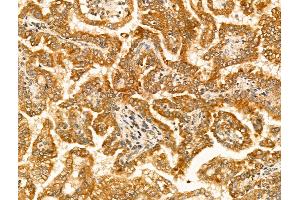 ABIN6265828 and ABIN6269033 at 1/100 staining Human kidney cancer by IHC-P. (TYR 抗体  (C-Term))
