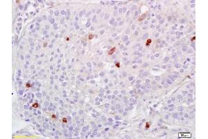Formalin-fixed and paraffin embedded human lung carcinoma labeled with Anti-ADAMTS1 Polyclonal Antibody, Unconjugated (ABIN673404) at 1:200 followed by conjugation to the secondary antibody and DAB staining. (ADAMTS1 抗体  (AA 851-967))