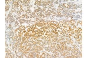 ABIN6258586 and ABIN6274433 at 1/100 staining human renal cell carcinoma by IHC-P. (ANKK1 抗体  (Internal Region))
