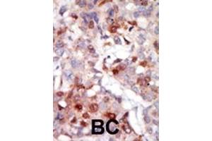 Formalin-fixed and paraffin-embedded human cancer tissue reacted with the primary antibody, which was peroxidase-conjugated to the secondary antibody, followed by AEC staining. (AKT3 抗体  (AA 88-118))
