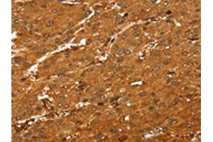 The image on the left is immunohistochemistry of paraffin-embedded Human liver cancer tissue using ABIN7189594(ABCC9 Antibody) at dilution 1/35, on the right is treated with synthetic peptide. (ABCC9 抗体)