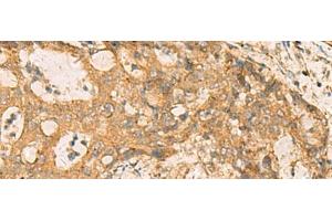 Immunohistochemistry of paraffin-embedded Human cervical cancer tissue using CNST Polyclonal Antibody at dilution of 1:70(x200) (CNST 抗体)
