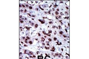 Formalin-fixed and paraffin-embedded human cancer tissue reacted with the primary antibody, which was peroxidase-conjugated to the secondary antibody, followed by AEC staining. (Adenylate Kinase 5 抗体  (N-Term))