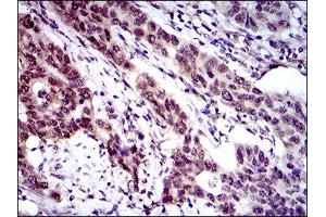 Immunohistochemical analysis of paraffin-embedded esophageal cancer tissues using CLGN mouse mAb with DAB staining. (Calmegin 抗体  (AA 249-405))
