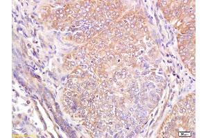 Formalin-fixed and paraffin embedded human breast carcinoma labeled with Anti Wnt6 Polyclonal Antibody, Unconjugated (ABIN762926) at 1:200 followed by conjugation to the secondary antibody and DAB staining (WNT6 抗体  (AA 281-365))