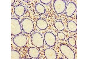 Immunohistochemistry of paraffin-embedded human gastric cancer using ABIN7147541 at dilution of 1:100 (HUS1 抗体  (AA 2-280))