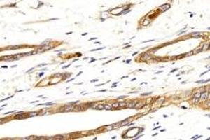 Immunohistochemistry analysis of paraffin-embedded human liver cancer using Integrin alpha V (ABIN7074314) at dilution of 1: 500 (CD51 抗体)