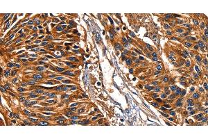 Immunohistochemistry of paraffin-embedded Human esophagus cancer tissue using Galectin 8 Polyclonal Antibody at dilution 1:50 (LGALS8 抗体)