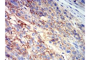 Immunohistochemical analysis of paraffin-embedded esophageal cancer tissues using CD147 mouse mAb with DAB staining. (CD147 抗体  (AA 138-323))