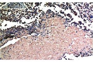 Immunohistochemistry of paraffin-embedded Human lung carcinoma tissue using AKT1 Monoclonal Antibody at dilution of 1:200. (AKT1 抗体)