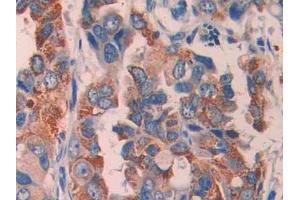 DAB staining on IHC-P; Samples: Human Breast cancer Tissue (ECT2 抗体  (AA 166-348))