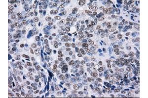 Immunohistochemical staining of paraffin-embedded Adenocarcinoma of colon tissue using anti-L1CAMmouse monoclonal antibody. (L1CAM 抗体)