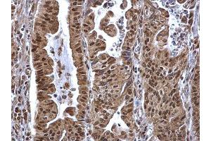 IHC-P Image SP1 antibody detects SP1 protein at nucleus on human gastric carcinoma by immunohistochemical analysis. (SP1 抗体  (C-Term))