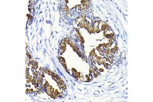 Immunohistochemistry of paraffin-embedded human prostate cancer using KLK3 Rabbit pAb (ABIN3022794, ABIN3022795, ABIN3022796 and ABIN6219231) at dilution of 1:100 (40x lens). (Prostate Specific Antigen 抗体  (AA 1-100))