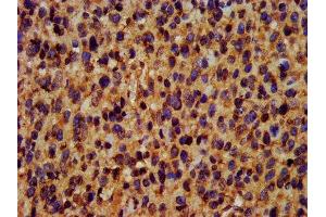 IHC image of ABIN7173439 diluted at 1:400 and staining in paraffin-embedded human glioma performed on a Leica BondTM system. (TRIM35 抗体  (AA 1-206))