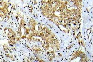 Immunohistochemistry analysis Phospho-Abl1 antibody in paraffin-embedded human breast carcinoma tissue. (ABL1 抗体  (pTyr412))