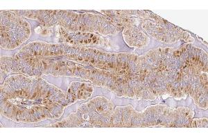 ABIN6267093 at 1/100 staining Human thyroid cancer tissue by IHC-P. (ATG13 抗体  (pSer355))