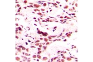 Immunohistochemical analysis of HOXB9 staining in human breast cancer formalin fixed paraffin embedded tissue section. (HOXB9 抗体  (C-Term))