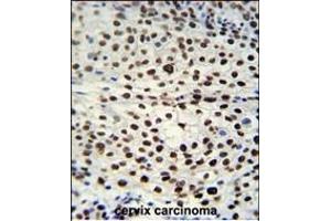 HNRB Antibody (N-term) (ABIN651713 and ABIN2840371) immunohistochemistry analysis in formalin fixed and raffin embedded human cervix carcinoma followed by peroxidase conjugation of the secondary antibody and DAB staining. (HNRNPAB 抗体  (N-Term))