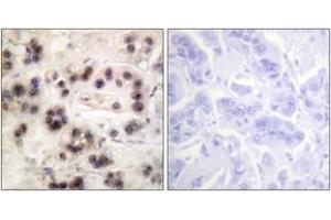Immunohistochemistry analysis of paraffin-embedded human breast carcinoma, using p63 (Phospho-Ser455) Antibody. (TCP1 alpha/CCTA 抗体  (pSer455))