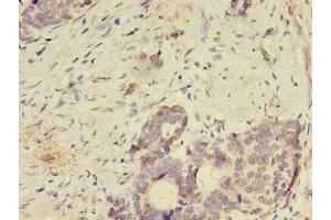 Immunohistochemistry of paraffin-embedded human gastric cancer using ABIN7166144 at dilution of 1:100