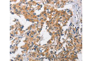 Immunohistochemistry of Human gastric cancer using CHMP1A Polyclonal Antibody at dilution of 1:60 (CHMP1A 抗体)