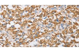 Immunohistochemistry of paraffin-embedded Human thyroid cancer tissue using CENPO Polyclonal Antibody at dilution 1:40 (CENPO 抗体)